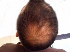 Alopecia-cc3-by-Welshs נשירת שיער. מקור: ויקיפדיה ברשיון שימוש cc3-by. צילום: Welshs